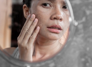 Nám da lâu năm liệu còn có thể cứu vãn? Tham khảo ngay để có làn da đẹp